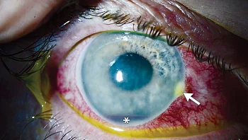 דבורה עקצה אותו בעין והרופאים לא הצליחו להסיר את העוקץ