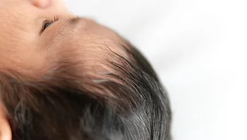 תינוקות למטופלים לנשירת שיער עשויים לפתח תסמונת איש הזאב
