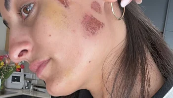 ״רק אחרי כמה שעות התעוררתי״: ירדן ג'רבי עם פרטים על התאונה