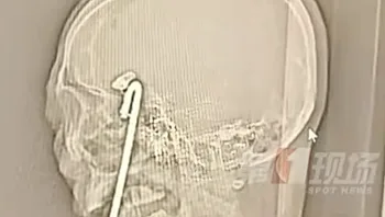 גבר השתכר ונפל על מוט מתכת שחדר דרך פיו - אבל היה לו מזל גדול