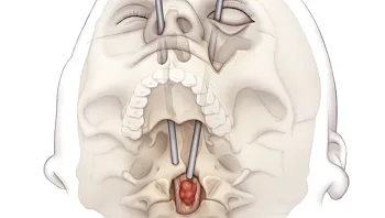 רופאים הצליחו להסיר גידול מחוט השדרה של צעירה דרך העין