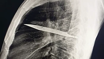 חי במשך 8 שנים עם סכין בתוך החזה מבלי להיות מודע לכך