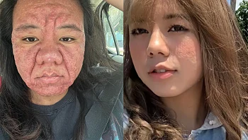 בת 28 נכנסה להיריון – וזה מה שקרה לפנים שלה