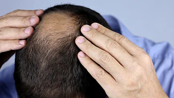 מה אומרים המחקרים על טיפולים טבעיים לנשירת שיער?