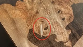 רופאים הסירו מדחום שבור שהיה נעוץ בישבנה של המטופלת 22 שנה