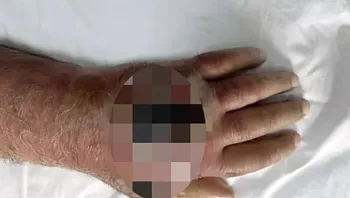 בן 60 כמעט איבד את זרועו לאחר שננשך על ידי גבר אחר