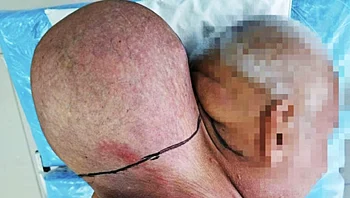 התעלם מהגידול בצווארו במשך 16 שנה עד שהגיע לגודל של ראשו