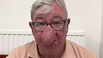 סבל במשך 6 שנים עם אף מנופח בגלל תסמונת נדירה