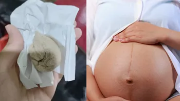 חודש לאחר הלידה גילתה שהרופאים שכחו בגופה ציוד רפואי