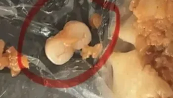 מה קורה בסין? עוד ועוד אנשים מוצאים שיניים אנושיות במזון