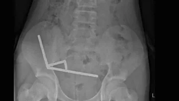 נער בן 13 כמעט נהרג לאחר שבלע 100 מגנטים חזקים שרכש ברשת