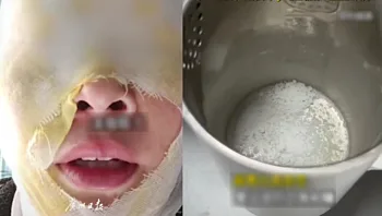 ניסתה לנקות אבנית בשיטה שלמדה מהאינטרנט - וזה מה שקרה לה