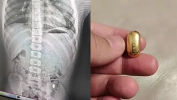 "הצואה שלו יקרה": ילד בן 11 בלע בטעות פיסת זהב במשקל 10 גרם