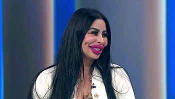 "תחזוקה של שנים": הכירו את האישה שמכורה לניתוחים פלסטיים