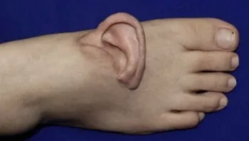 רופאים השתילו אוזן שנתלשה בתאונה על כף רגל של מטופלת