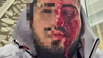 שוחח בעברית בקפריסין, הותקף במכות קשות - ואיבד את עינו