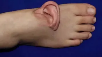 אוזן של אישה הוחזרה לראשה לאחר חמישה חודשי "שימור" על כף הרגל