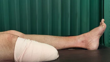 חלם להתקבל לבית ספר לרפואה - והחליט לכרות לעצמו את הרגל