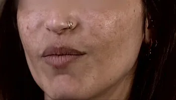 הטיפול המסוכן לפנים בלייזר: "לא מסוגלת להסתכל על עצמי במראה"