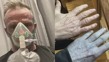 "אווטאר" במציאות: גבר התעורר עם עור כחול - מסיבה מצחיקה