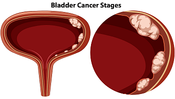 סרטן שלפוחית השתן: מה שחשוב לדעת