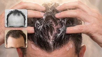 הסוף לשערות על הכרית: השמפו הטבעי שעוצר את הנשירה מהשורש