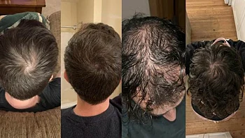 המאבק בדלילות השיער: פריצת הדרך המדעית שמשנה את מה שידענו על שיקום השיער מהשורש