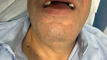 נהג אוטובוס הותקף בי-ם ע"י נערים ששברו את שיניו: "עוד גבול נחצה"