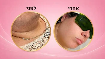 מכון הלייזר בלוד שמציע חוויית טיפול אחרת
