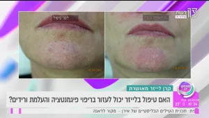 איך מרפאים פיגמנטציה ומעלימים ורידים באמצעות טיפול לייזר?