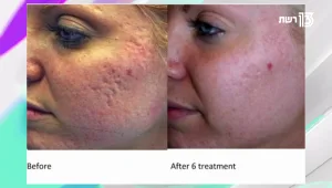 איך מעלימים את הצלקות שמשאירים פצעי האקנה?