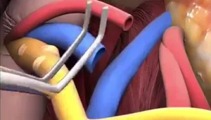 תיאור מפורט של הניתוח השכיח בישראל