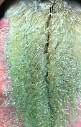 כתוצאה מעישון ואנטיביוטיקה: לשונו של גבר הפכה ירוקה ושעירה