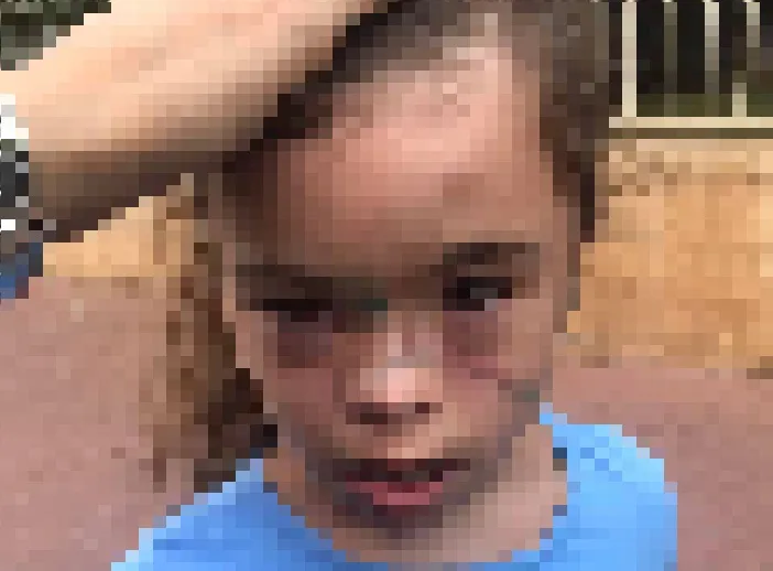 ילדה עם תסמונת דאון שהוכתה