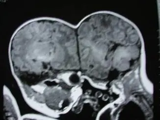 צילום של התאומות הסיאמיות מחוברות בראשם