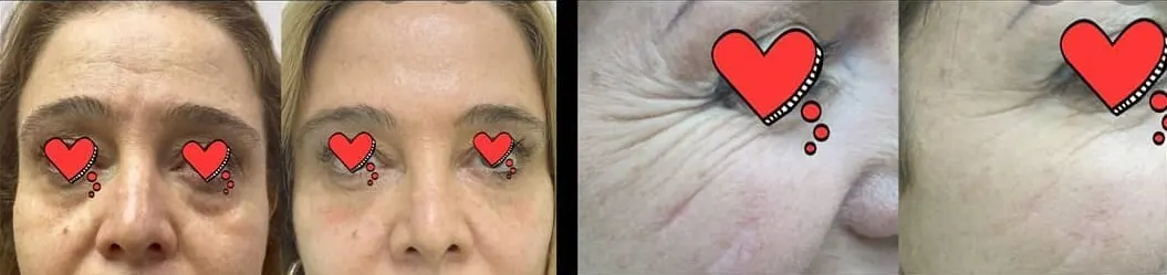 מילוי שקעים והבהרת עור כהה מתחת לעיניים - HD ביוטי