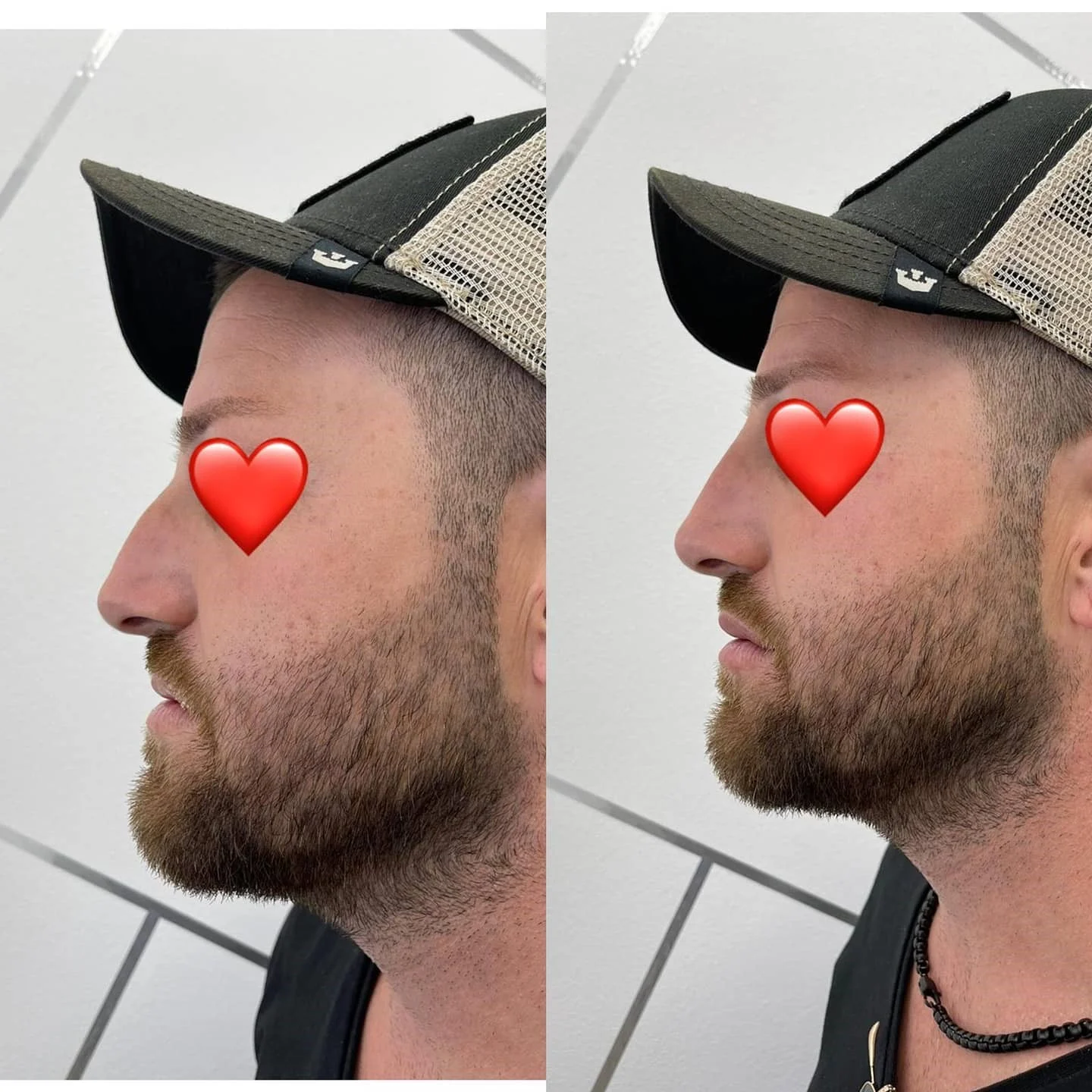 גם גברים משתדרגים. פיסול אף בחמש דקות - HD ביוטי