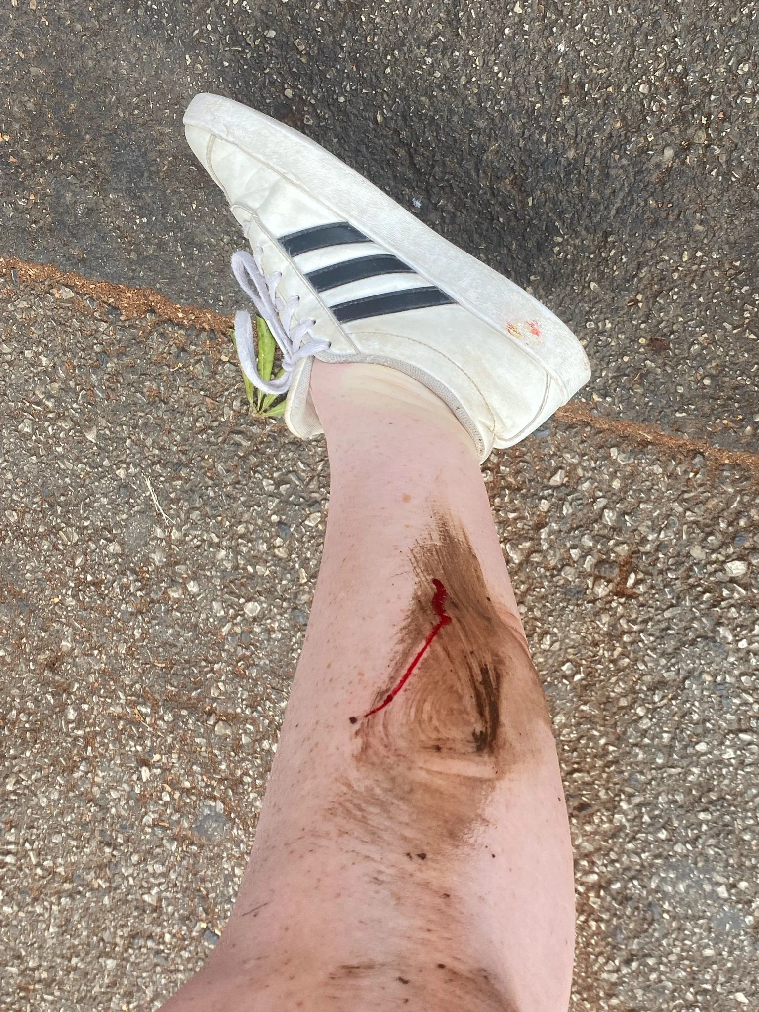 פציעתה של הנערה שהותקפה על ידי חזיר בר בחיפה