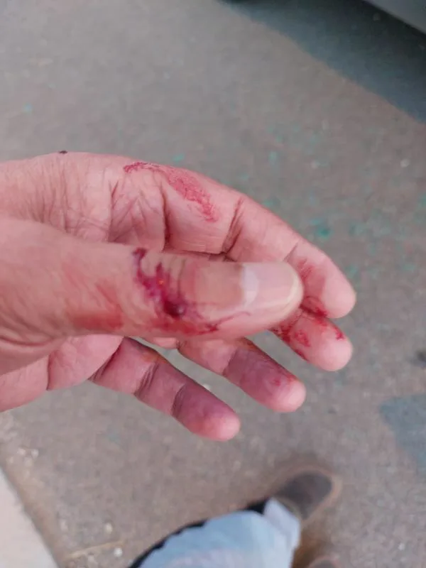 הפציעה שנגרמה לתושב מיתר שייודו לעבר אבנים