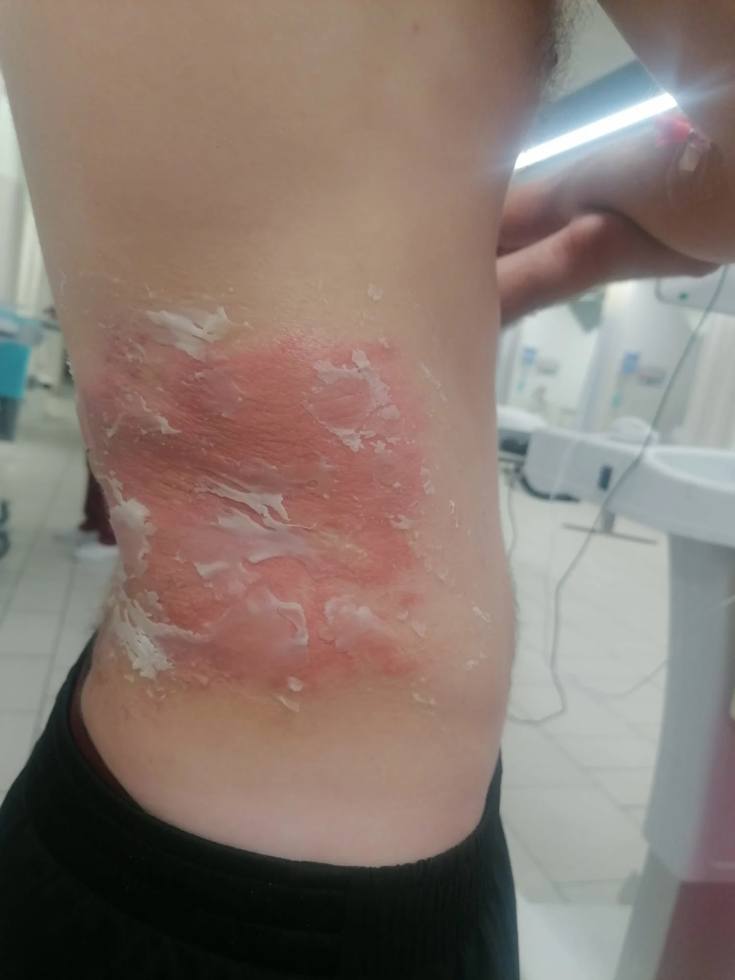 הצעיר שנפגע ממדוזה