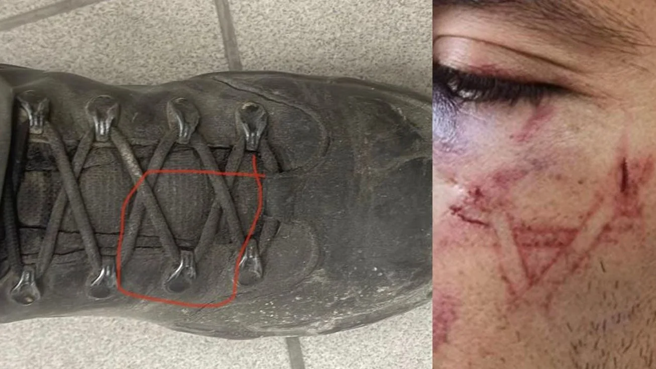 העצור ממזרח ירושלים שעל פניו סימן של מגן דוד